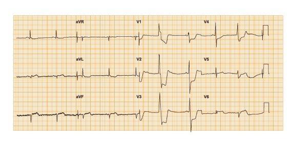 3 Image Electrocardiographique De Lesion Ischemie Aigue Anomalies Du Segment St Ecg Pratique Revue Medicale Suisse