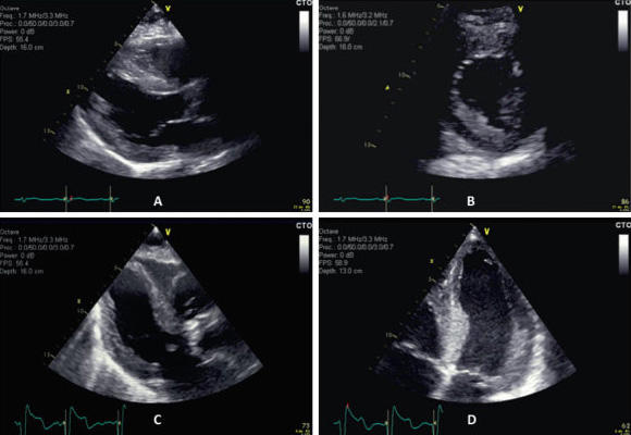 Decouverte D Une Hypertrophie Ventriculaire Gauche A L Echocardiographie Adulte