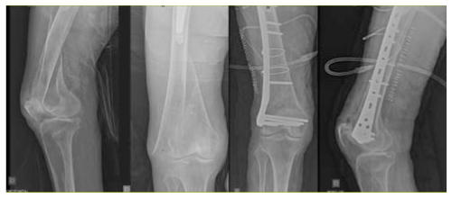Chirurgie / traitement de la fracture de la rotule - Clinique du genou Paris