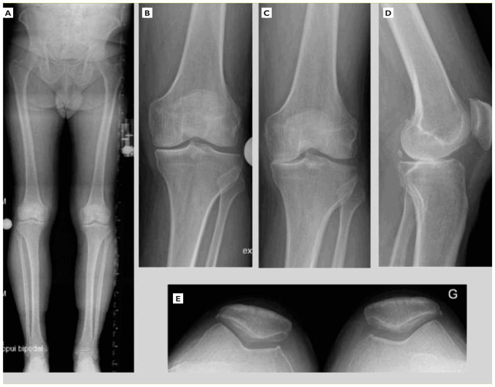 Arthrose et Prothèses de genou – Chirurgie Orthopédique & Sportive