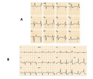 Pacemaker 5. Dysfonctionnement : e-cardiogram