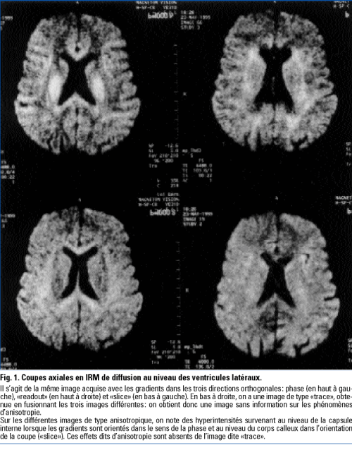 Imagerie Cérébrale De Diffusion Revue Médicale Suisse